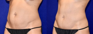 Left 3/4 View - Tummy Tuck