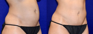 Right 3/4 View - Tummy Tuck