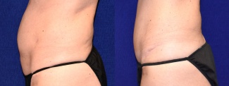 Left Profile View - Tummy Tuck