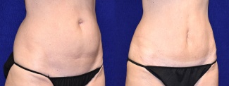 Right 3/4 View - Tummy Tuck