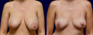 Frontal View - Breast Implant Removal with Breast Lift