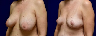 Left 3/4 View - Breast Implant Removal with Breast Lift