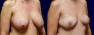 Right 3/4 View - Breast Implant Removal with Breast Lift