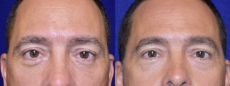 Frontal View - Lower Eyelid Surgery