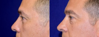 Left Profile View - Lower Eyelid Surgery
