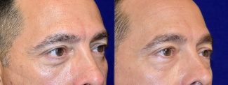 Right 3/4 View - Lower Eyelid Surgery