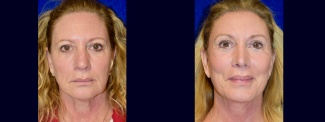 Frontal View - Facelift, Browlift, Rhinoplasty