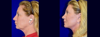Left Profile View - Facelift, Browlift, Rhinoplasty