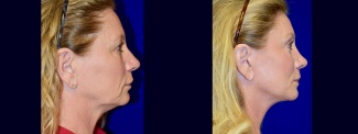 Right Profile View - Facelift, Browlift, Rhinoplasty