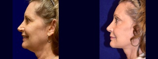 Left Profile View - Facelift, Browlift