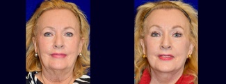 Frontal View - Facelift, Browlift