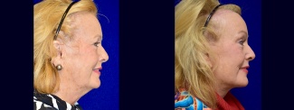 Right Profile View - Facelift, Browlift
