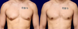 Frontal View - Male Breast Reduction