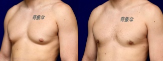 Left 3/4 View - Male Breast Reduction