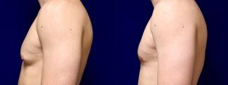 Left Profile View - Male Breast Reduction