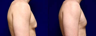 Right Profile View - Male Breast Reduction