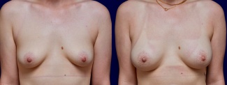 Frontal View - Breast Augmentation