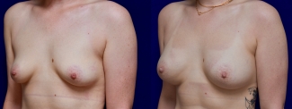 Left 3/4 View - Breast Augmentation