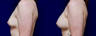 Left Profile View - Breast Augmentation