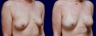 Right 3/4 View - Breast Augmentation