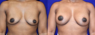 Frontal View - Breast Augmentation