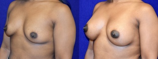 Left 3/4 View - Breast Augmentation