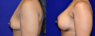 Left Profile View - Breast Augmentation