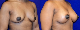 Right 3/4 View - Breast Augmentation