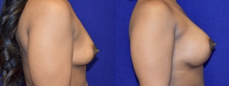 Right Profile View - Breast Augmentation