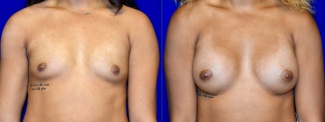 Frontal View - Breast Augmentation