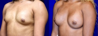 Left 3/4 View - Breast Augmentation