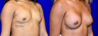 Right 3/4 View - Breast Augmentation
