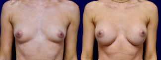 Frontal View - Breast Augmentation