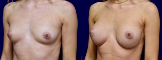 Left 3/4 View - Breast Augmentation