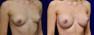 Right 3/4 View - Breast Augmentation