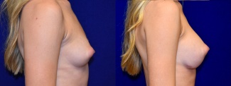 Right Profile View - Breast Augmentation