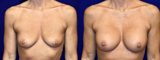 Frontal View - Breast Augmentation