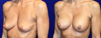 Left 3/4 View - Breast Augmentation