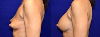 Left Profile View - Breast Augmentation