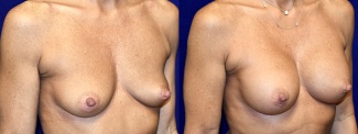 Right 3/4 View - Breast Augmentation