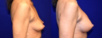 Right Profile View - Breast Augmentation