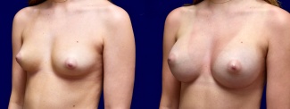 Left 3/4 View - Breast Augmentation