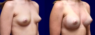 Right 3/4 View - Breast Augmentation