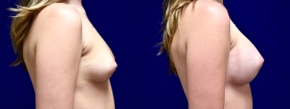 Right Profile View - Breast Augmentation