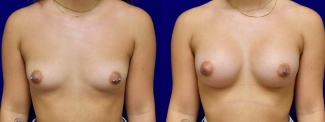 Frontal View - Breast Augmentation