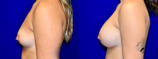 Left Profile View - Breast Augmentation