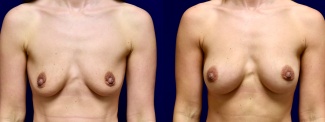 Frontal View - Breast Augmentation