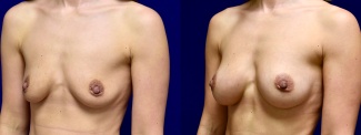 Left 3/4 View - Breast Augmentation