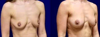 Right 3/4 View - Breast Augmentation