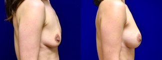 Right Profile View - Breast Augmentation